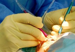 Oční chirurgové Pardubické nemocnice operují šedý zákal s technickou novinkou